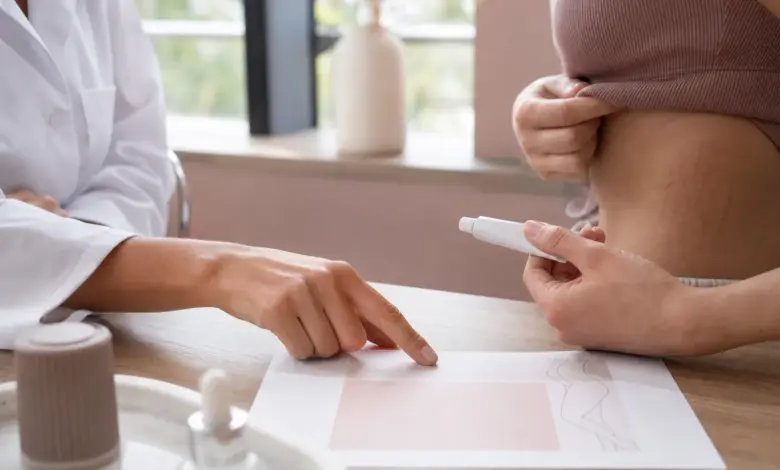 Tretinoin gegen Dehnungsstreifen: Wirkung und Risiken 4 Dermatologische Beratung zur Anwendung einer Creme bei frühen Dehnungsstreifen